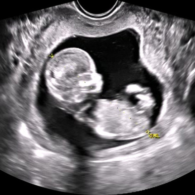 adv_first_trimester_ultrasound__86302.1652909936.386.513