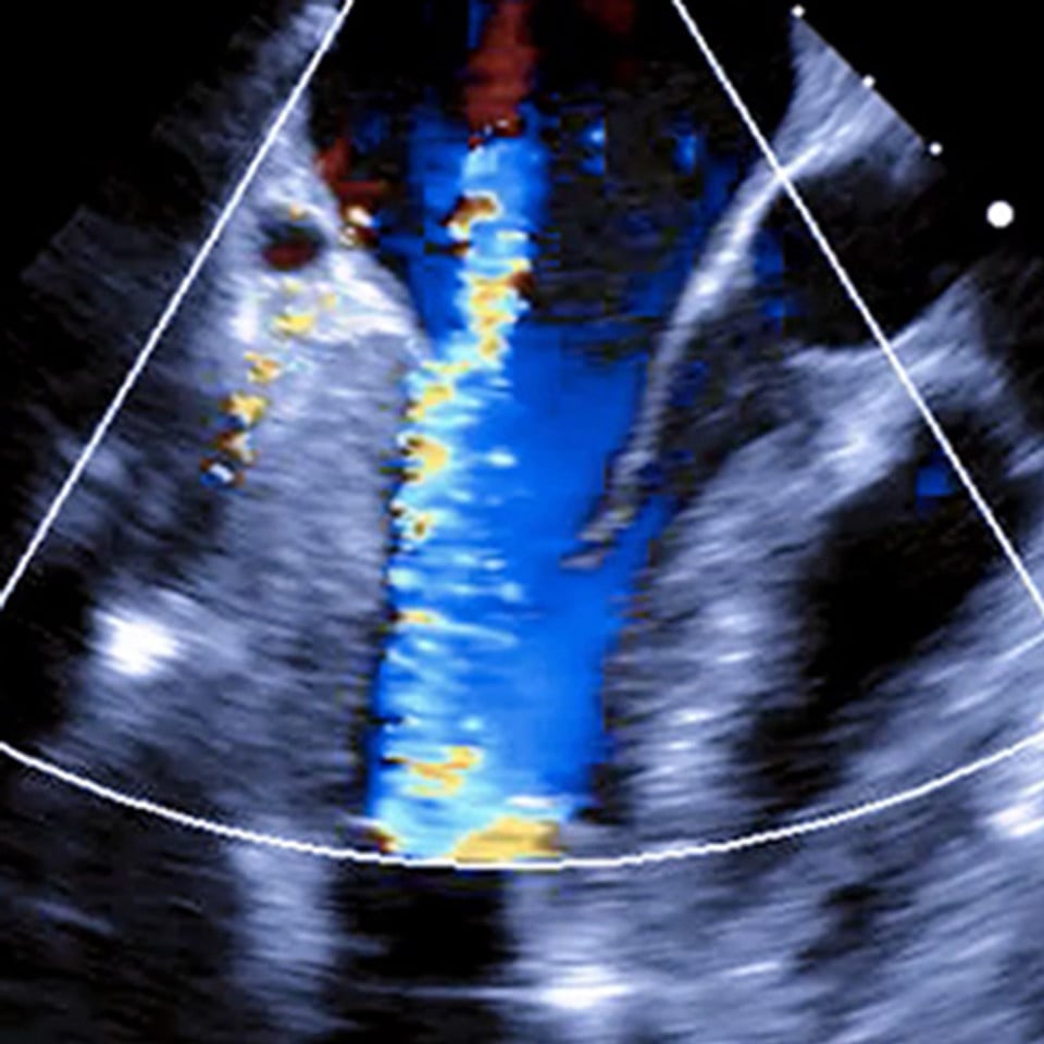adv_lvad_ultrasound__15558