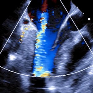adv_lvad_ultrasound__15558 adv_lvad_ultrasound__15558