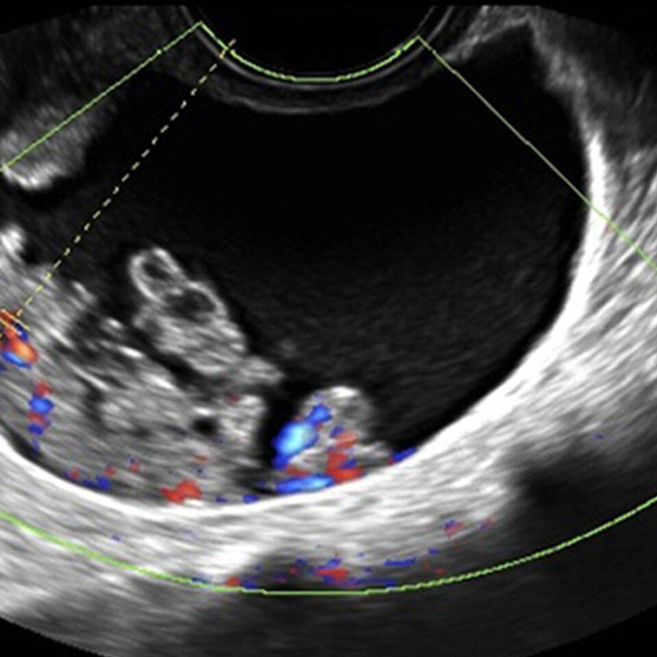 adv_malignant_adnexal_ultrasound__80126