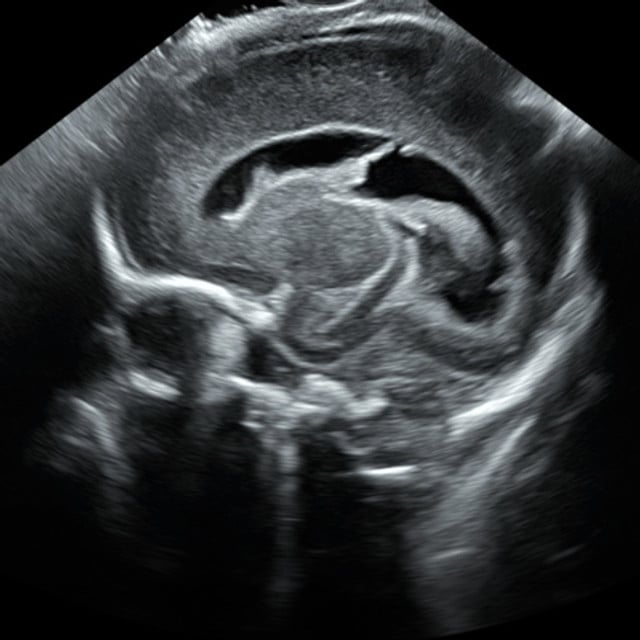 adv_neonatal_ultrasound