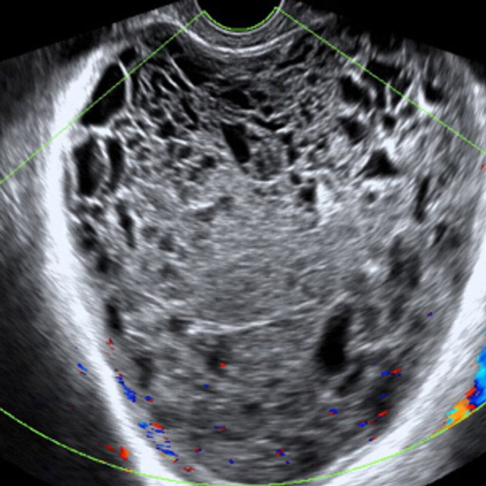 adv_nonmalignant_adnexal_ultrasound__60668