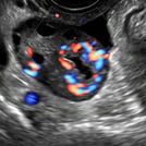 Image of a GYN Ultrasound showcasing Normal Adnexa, part of SonoSim's Advanced Clinical Series in ultrasound training