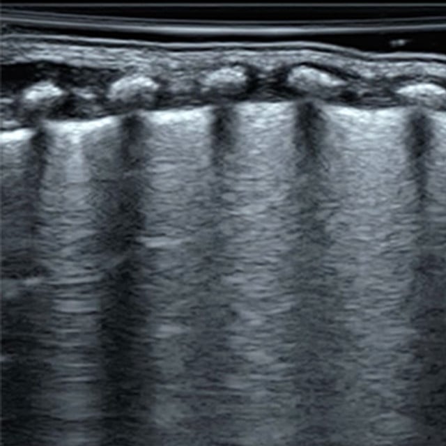 adv_peds_lung_ultrasound__63217