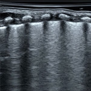 adv_peds_lung_ultrasound__63217 adv_peds_lung_ultrasound__63217