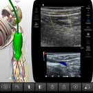Vascular Mapping for Preoperative Planning of Dialysis Access