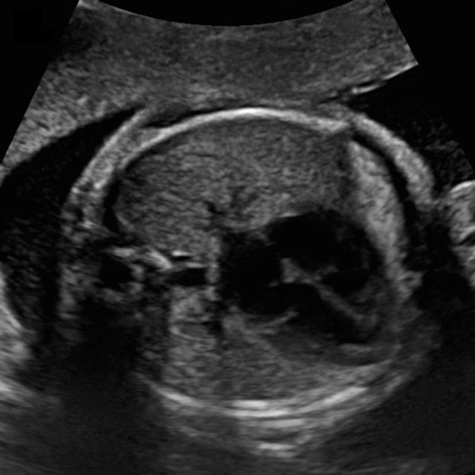 adv_second_third_trimester1_ultrasound__61020