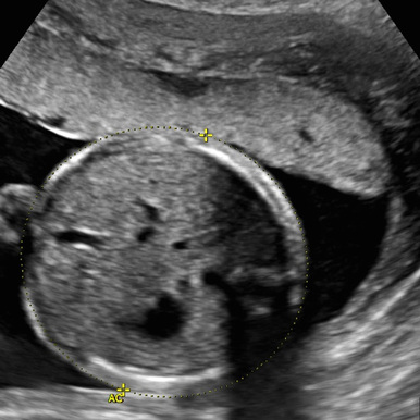 adv_second_third_trimester2_ultrasound__75082.1652910098.386.513