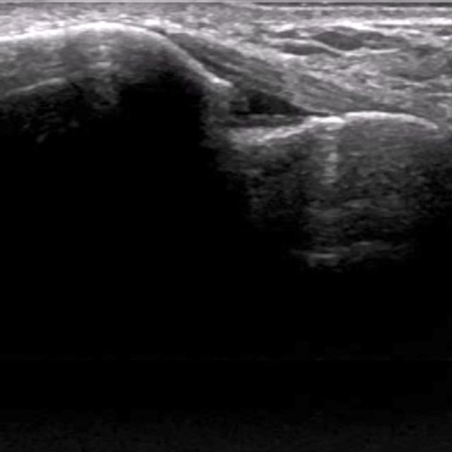 ankle_ultrasound__23590