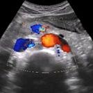 Ultrasound Image of an aorta IVC window from SonoSim Ultrasound Training