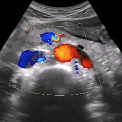 aorta_ivc_ultrasound__64954-1