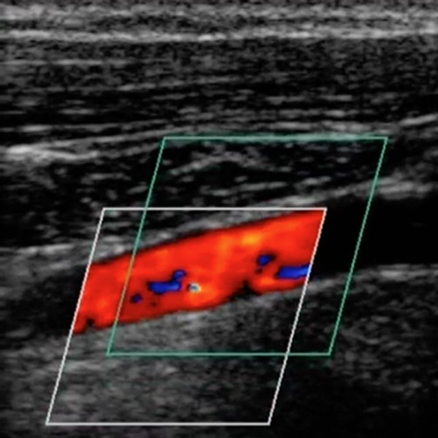 arm_arterial_ultrasound__40160