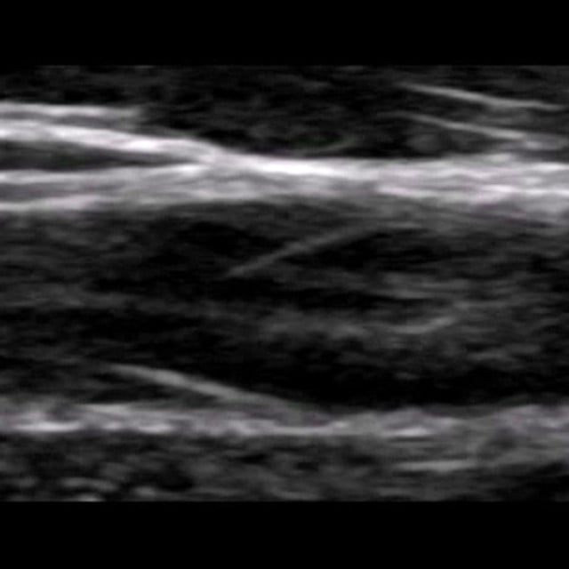 arm_venous_ultrasound__11795