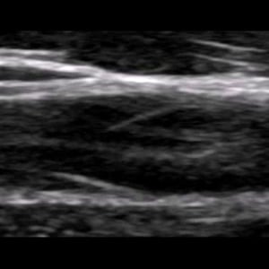 arm_venous_ultrasound__11795 arm_venous_ultrasound__11795