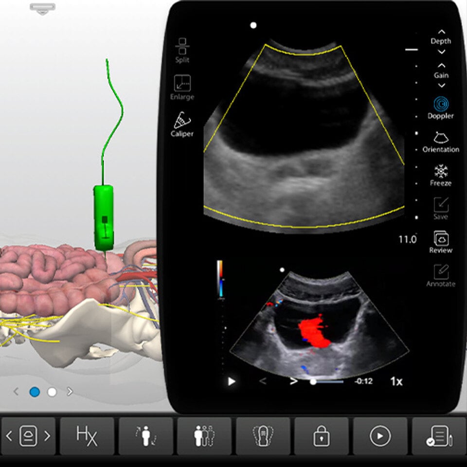 bladder_case_screen_1__62674 bladder_case_screen_1__62674