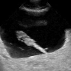 bladder_ultrasound__54325