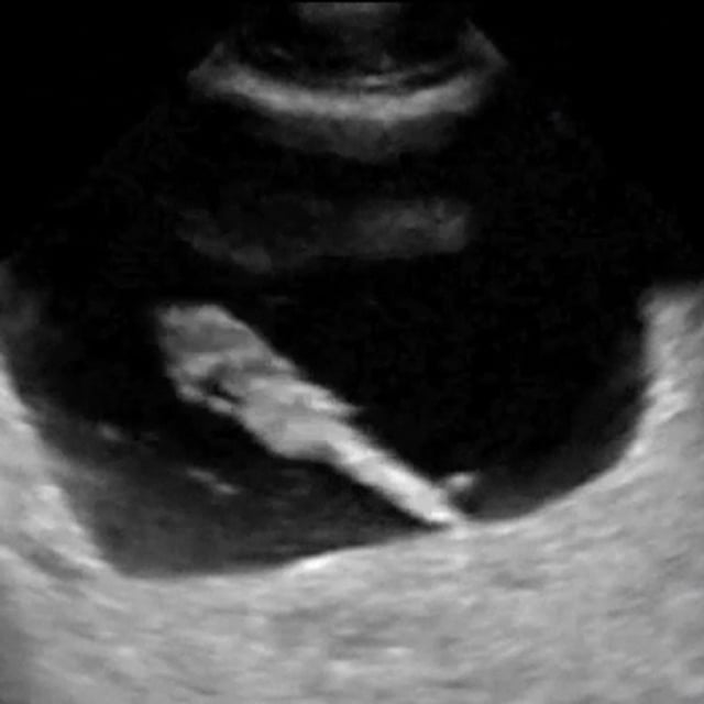 bladder_ultrasound__54325