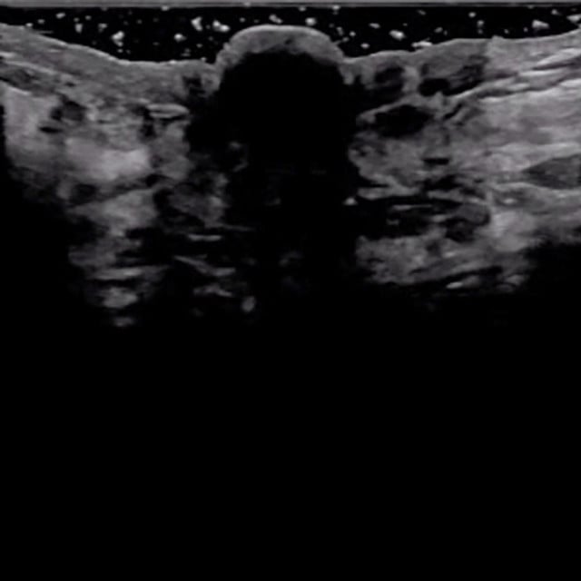 breast_ultrasound__30866