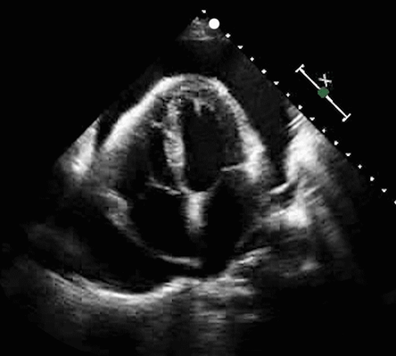Cardiac ultrasound footage with POCUS application of cardiac tamponade