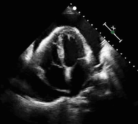 Cardiac ultrasound footage with POCUS application of cardiac tamponade Cardiac ultrasound footage with POCUS application of cardiac tamponade