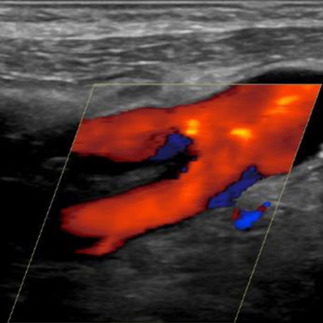 cerebrovascular_ultrasound__74756