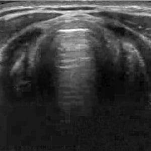 clinical_airway_ultrasound__49761 clinical_airway_ultrasound__49761