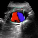 Clinical Ultrasound Training Image of Aorta and Inferior Vena Cava IVC by SonoSim