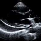 Clinical Ultrasound Training Image of Cardiology Scan by SonoSim