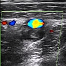 Clinical Ultrasound Training Image of a Deep Vein Thrombosis (DVT) Scan by SonoSim