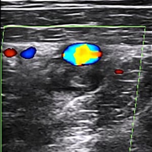 clinical_dvt_ultrasound clinical_dvt_ultrasound