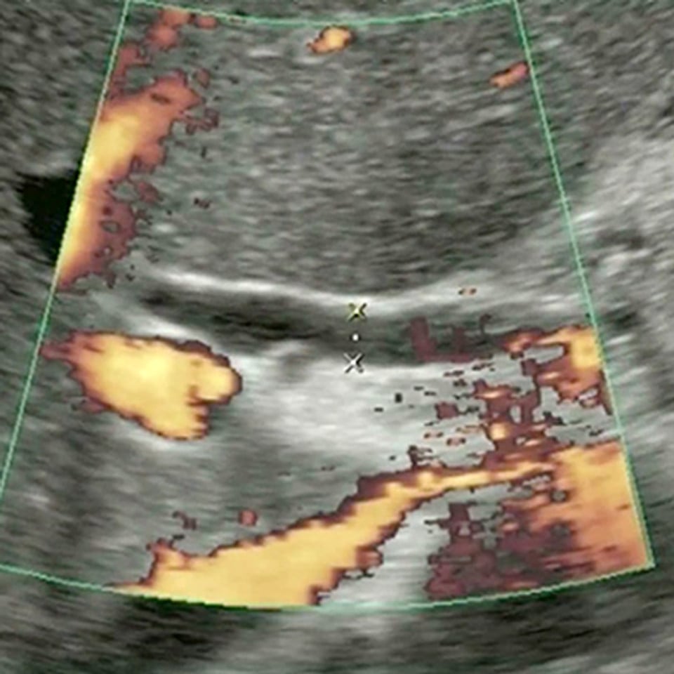 clinical_intestinal_ultrasound__76457