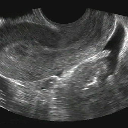 clinical_obgyn_ultrasound