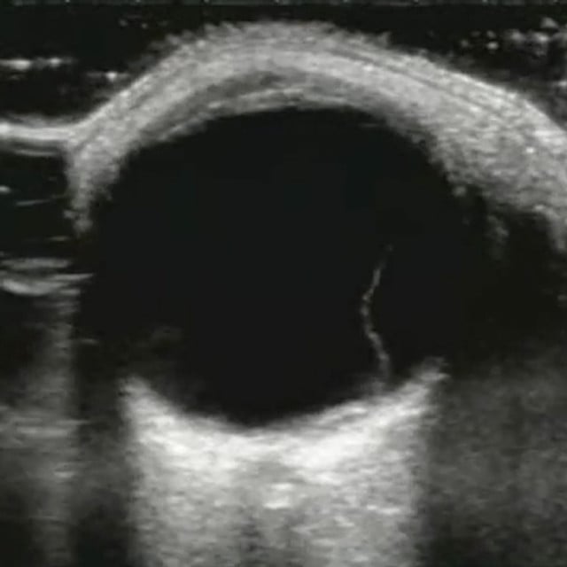clinical_ocular_ultrasound__58596