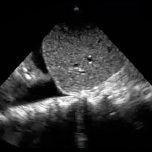 clinical_pulmonary_ultrasound__76351 clinical_pulmonary_ultrasound__76351