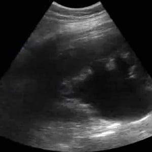 clinical_renal_ultrasound__08717