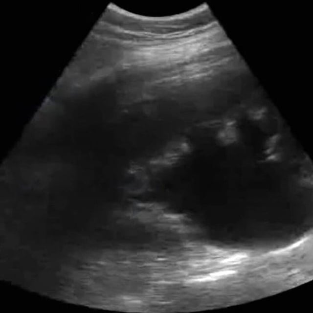 clinical_renal_ultrasound__08717