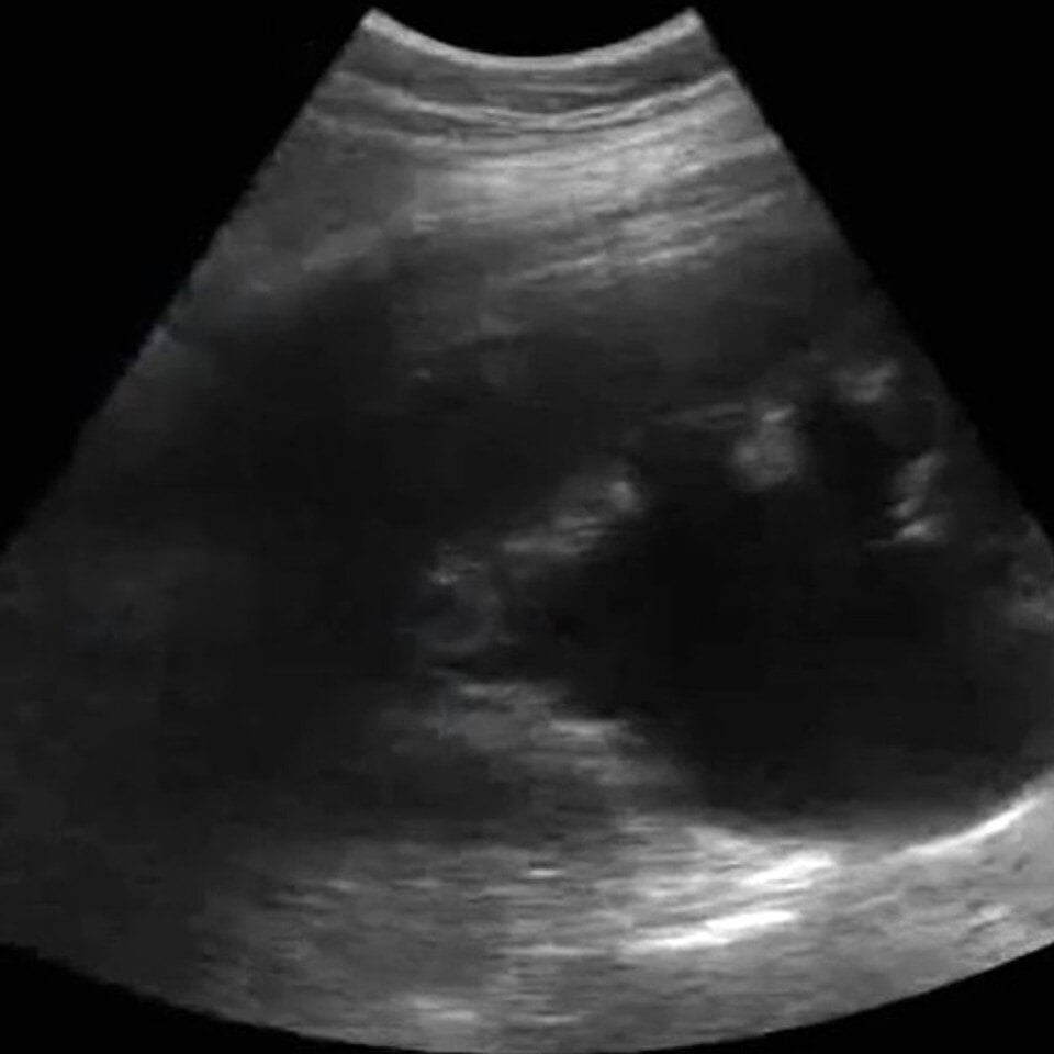 clinical_renal_ultrasound__08717