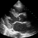Clinical Ultrasound Training Image of a Rapid Ultrasound in Shock (RUSH) Scan by SonoSim