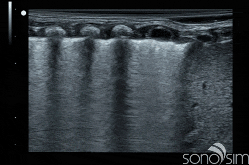 Ultrasound scan with pathology that is best understood through both SonoSim and bedside ultrasound practice