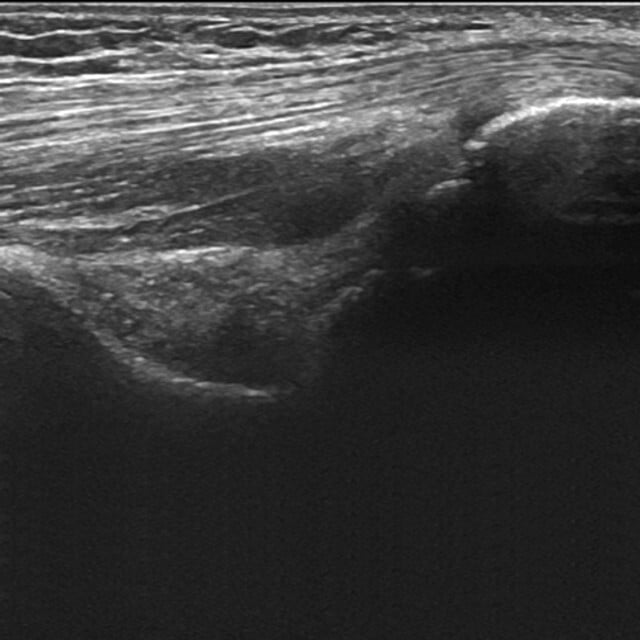 elbow_ultrasound__73973