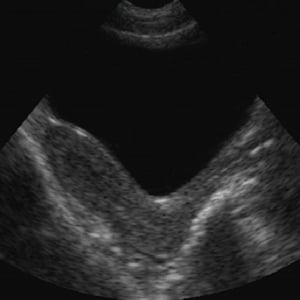 female_pelvis_ultrasound__94898