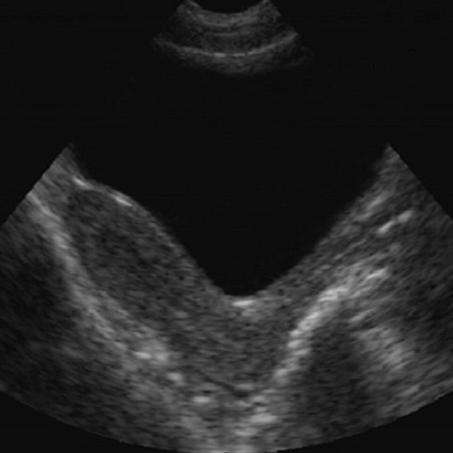 female_pelvis_ultrasound__94898