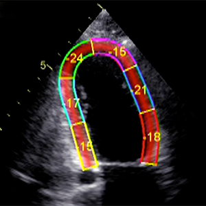 focus3_Cardiac Chamber_Quantification_thumbnail_