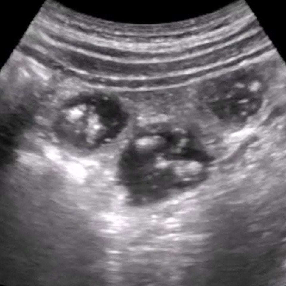 gi_tract_ultrasound__38516
