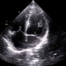 Heart Anatomy & Physiology Ultrasound Image from SonoSim Ultrasound Training