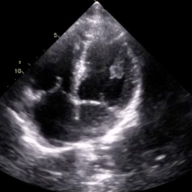 heart_ultrasound__96373