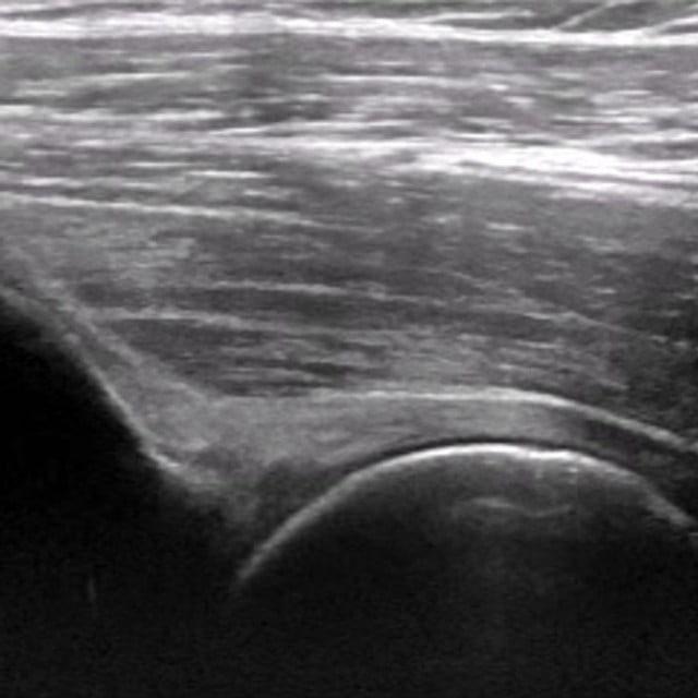 hip_ultrasound__99078