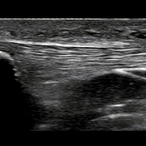 knee_ultrasound__21914-2