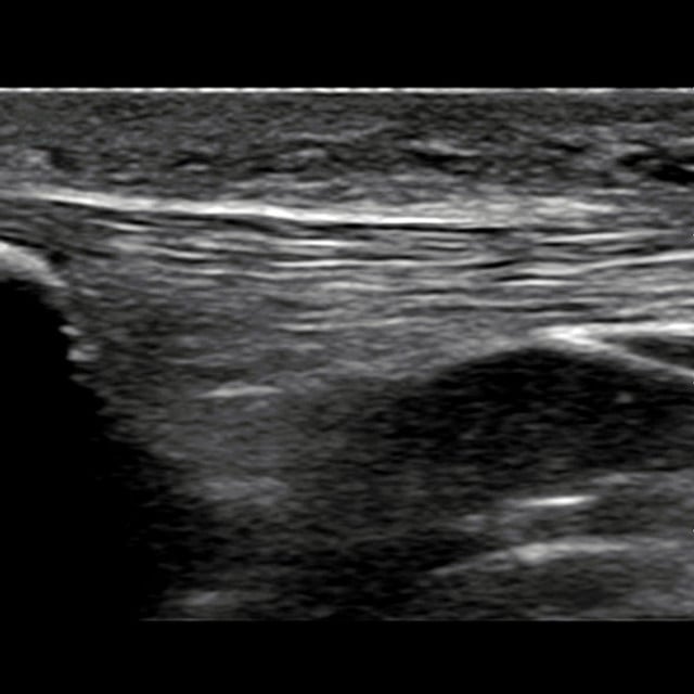 knee_ultrasound__21914-2