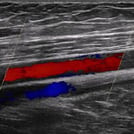 Leg Arterial Ultrasound Image from SonoSim Ultrasound Training